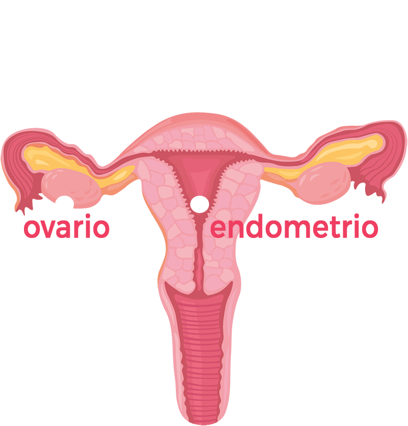 tumore ovario endometrio