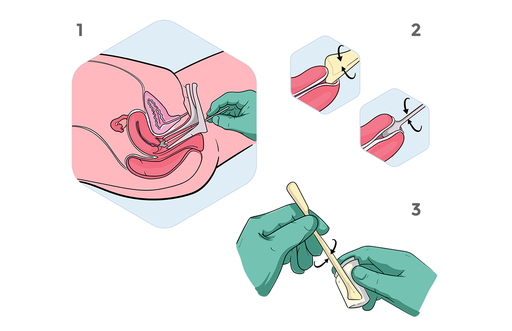 PAPNext Sampling Procedure